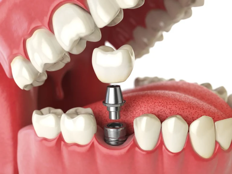 Navigating the Healing Process: What to Expect After Dental Implant Surgery